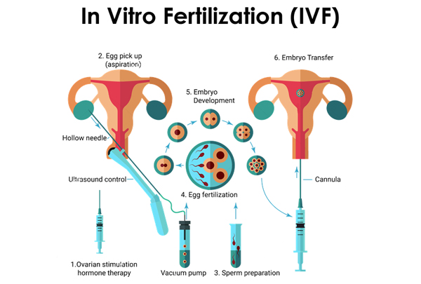 IVF