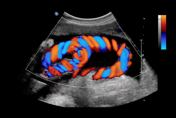 2D Color Doppler