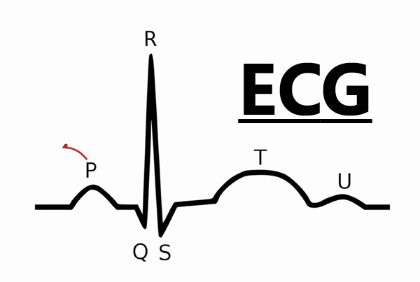 ECG