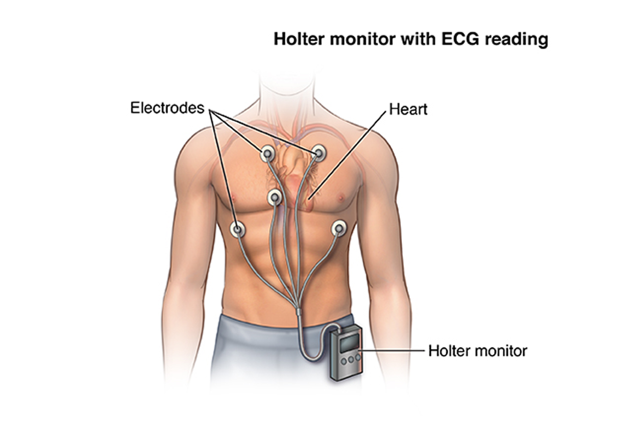 Holter Monitoring